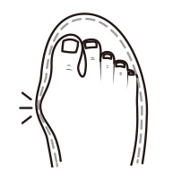 外反母趾